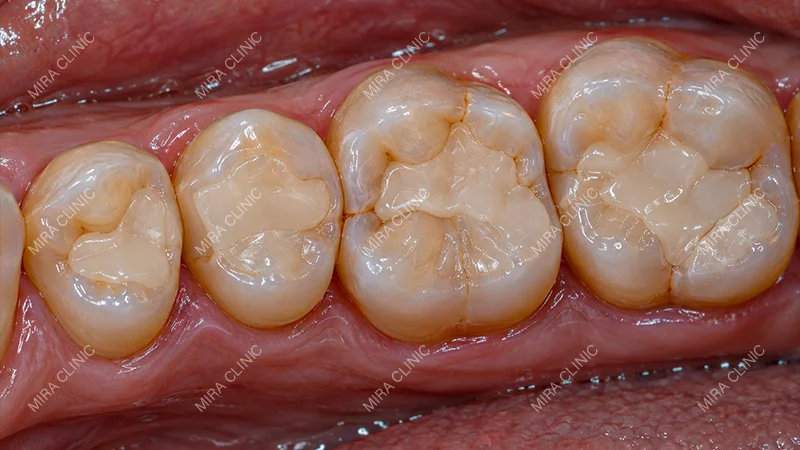 Large existing fillings